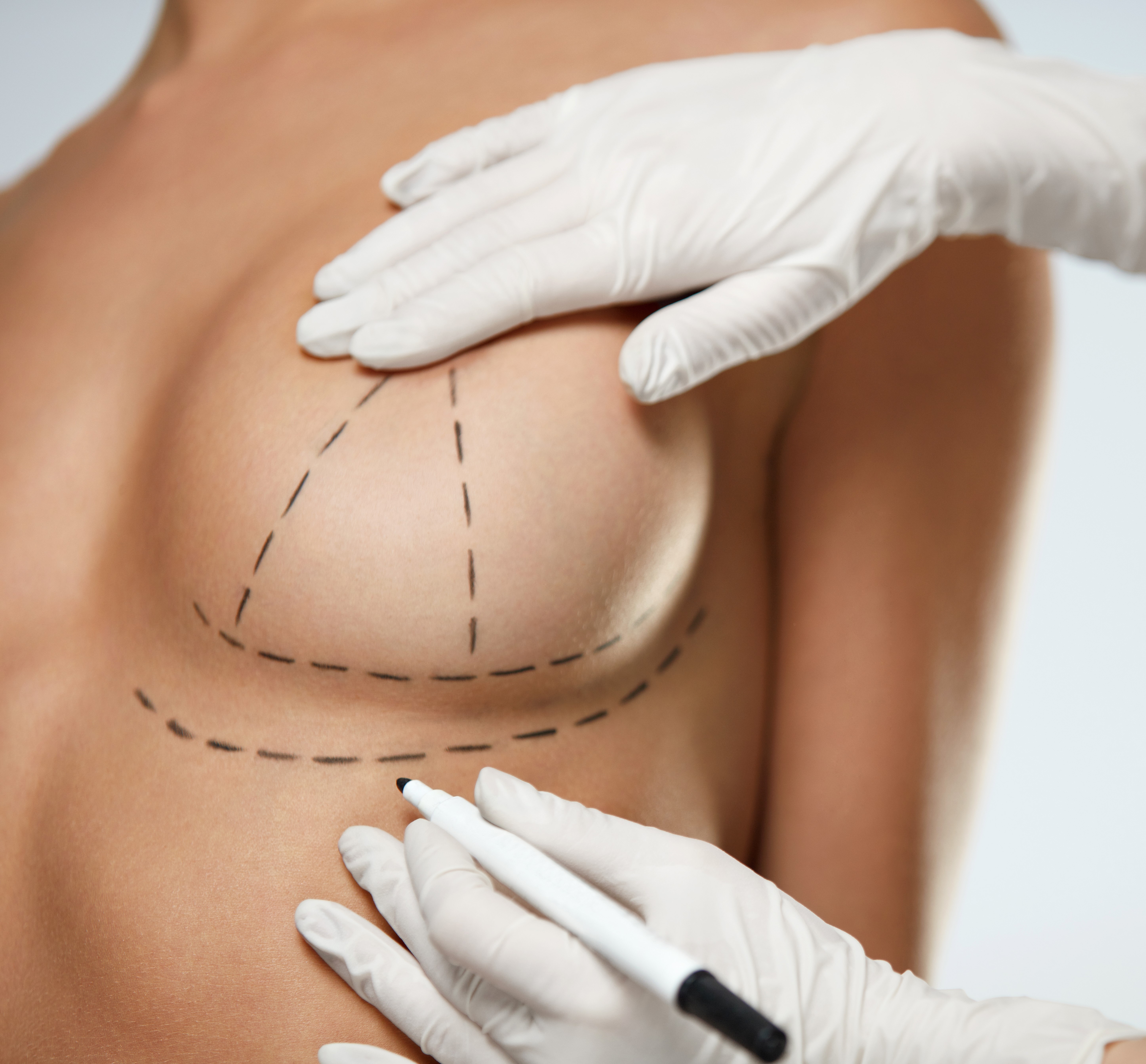 Brustvegrößerung mit Straffung