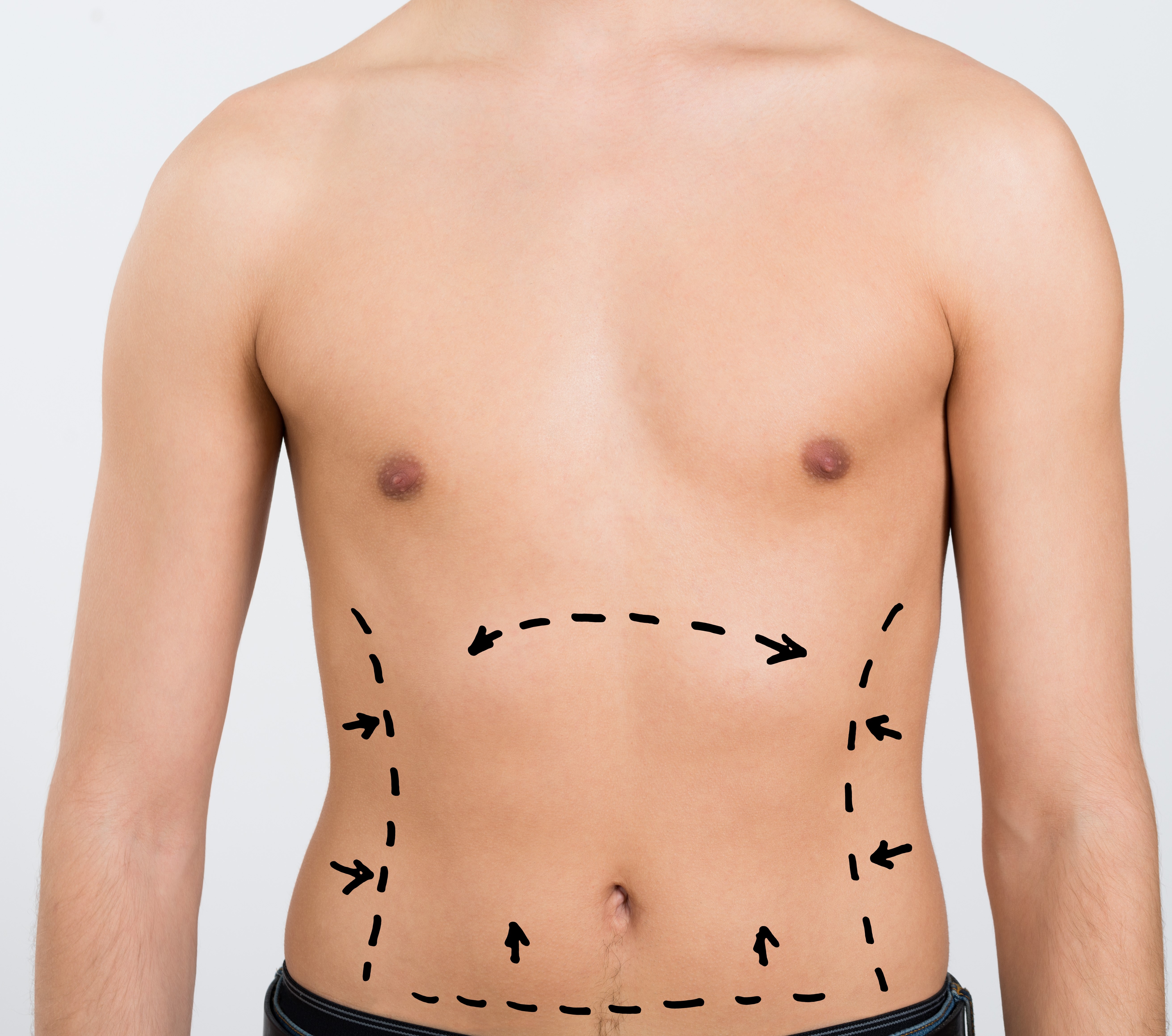 Fettabsaugung in Lokalanästhesie "S"