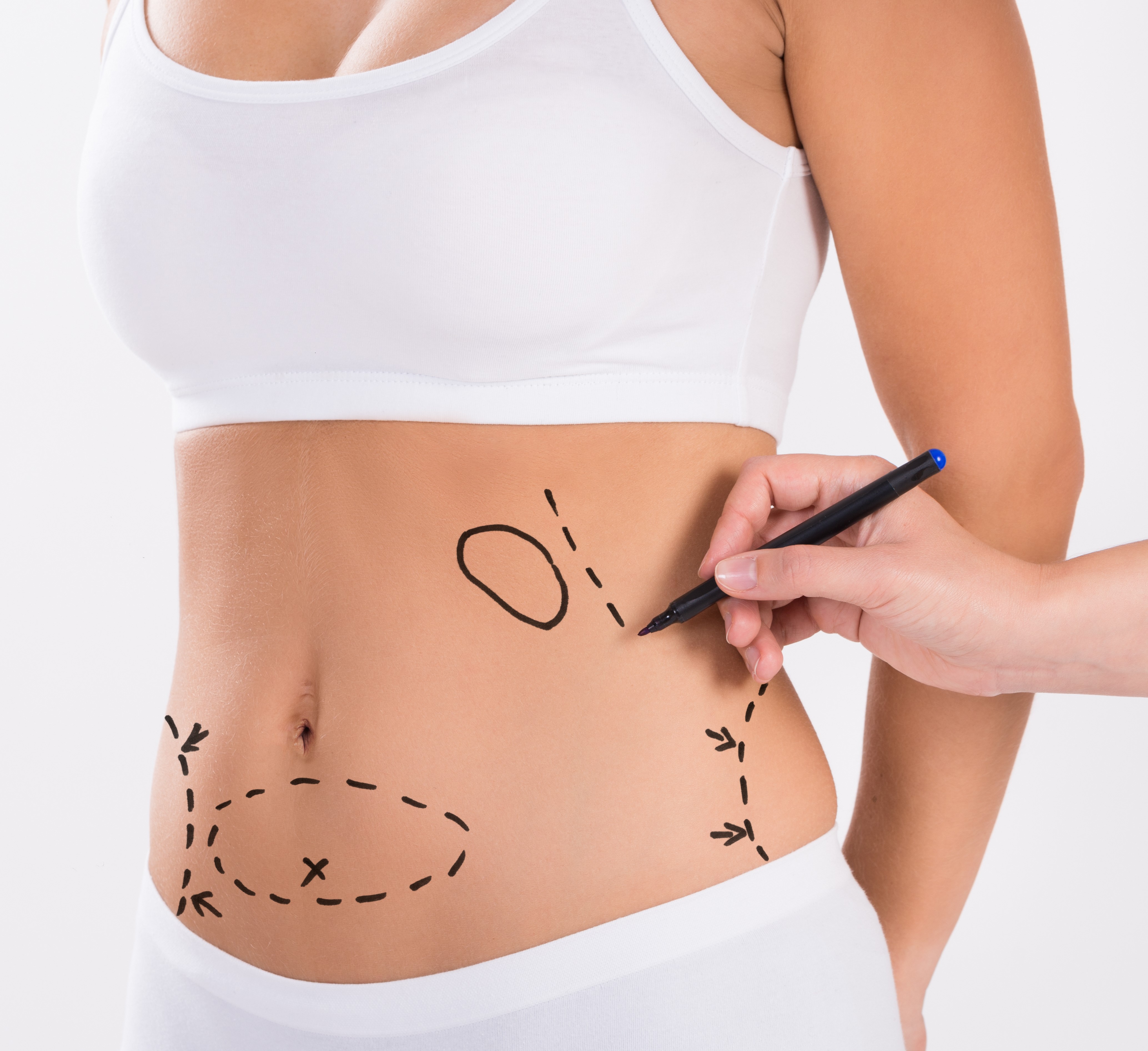 Fettabsaugung 3 Zonen in Vollnarkose