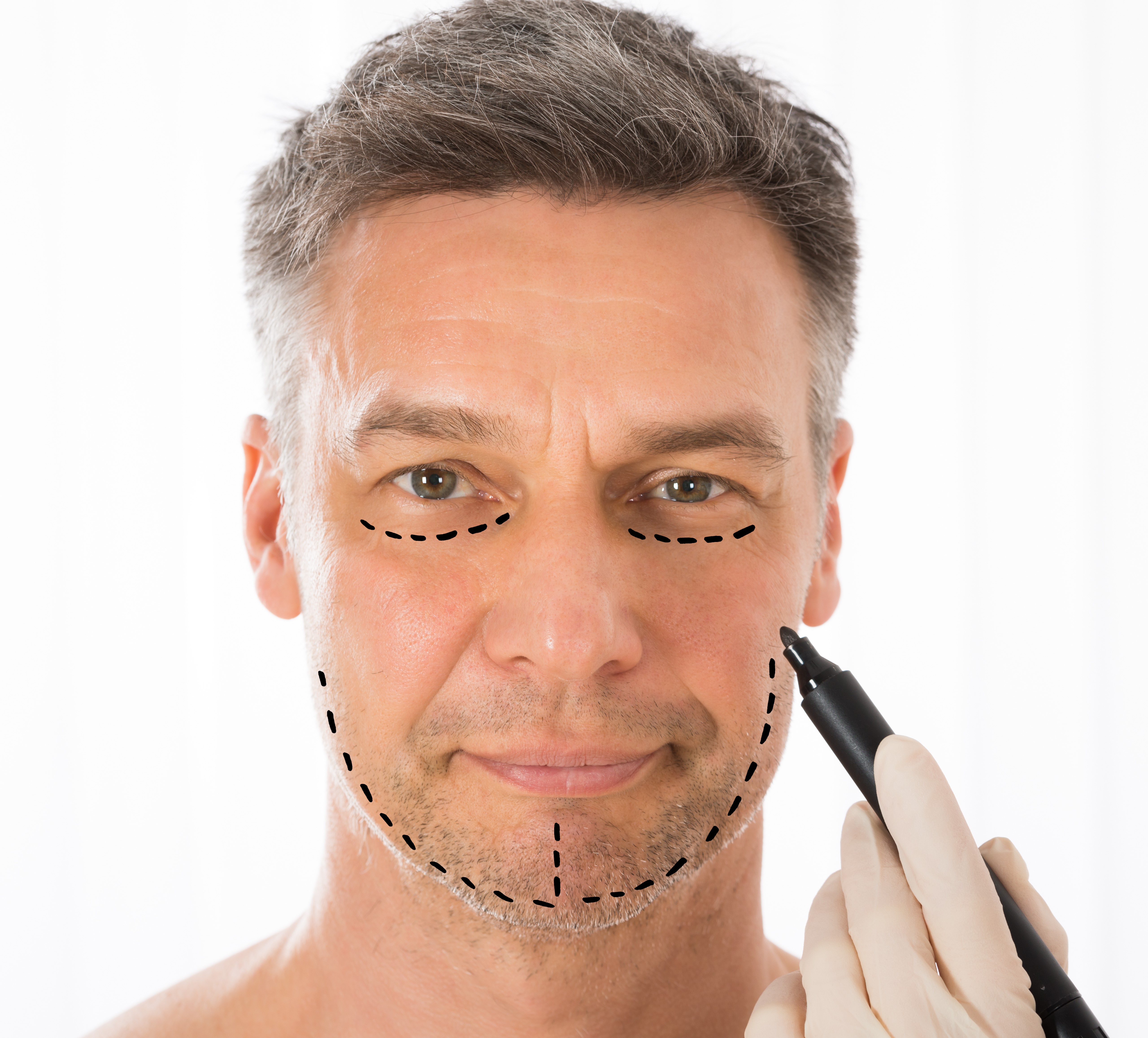 Browlifting, Schläfenlift, Augenbrauenkorrektur